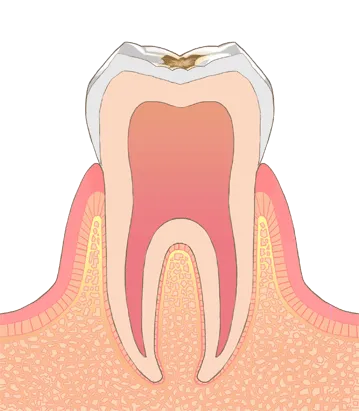 2エナメル質の虫歯（C1）