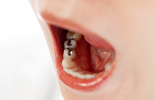 銀歯を白くしたい